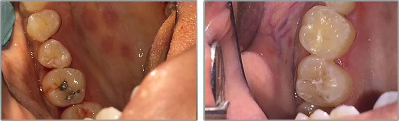 Amalgam Fillings. Before and After Photos: Patient 1 - frontal view