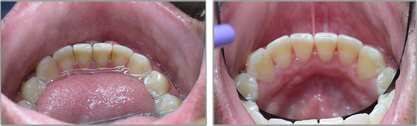 Porcelain Veneers. Before and After Photos: Patient 7 - frontal view