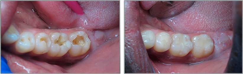 Non-metal Fillings. Before and After Photos: Patient 1 - frontal view