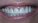 Before and After Photos: Teeth Whitening - frontal view, patient 1