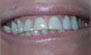 Teeth Whitening. Before and After Photos: Patient 1 - frontal view