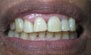 Teeth Whitening. Before and After Photos: Patient 2 - frontal view