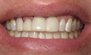Teeth Whitening. Before and After Photos: Patient 3 - frontal view