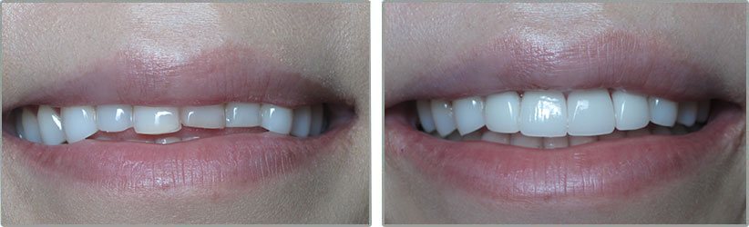 Porcelain Veneers. Before and After Photos: Patient 1 - frontal view