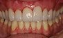 Porcelain Veneers. Before and After Photos: Patient 3 - close view