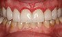 Porcelain Veneers. Before and After Photos: Patient 4 - frontal view