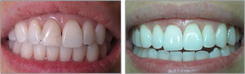 Porcelain Veneers. Before and After Photos: Patient 5 - frontal view