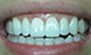 Porcelain Veneers. Before and After Photos: Patient 5 - frontal view