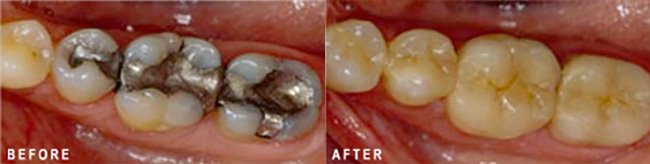 Photo: Before and After - Non-metal Fillings