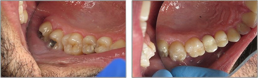 Dental Implants. Before and After Photos: Patient 10 - frontal view