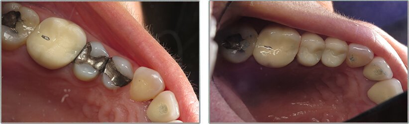 Dental Implants. Before and After Photos: Patient 12 - frontal view