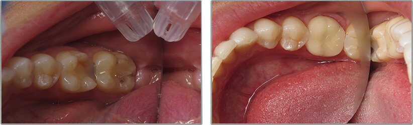 Dental Implants. Before and After Photos: Patient 13 - frontal view