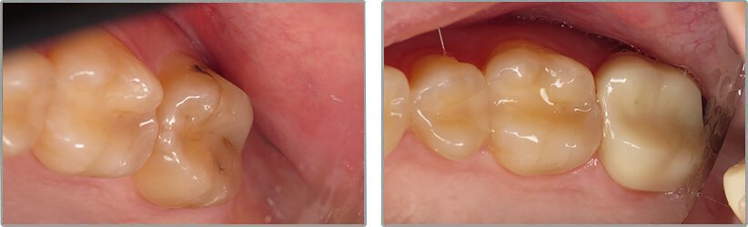 Dental Implants. Before and After Photos: Patient 14 - frontal view
