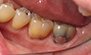 Dental Implants. Before and After Photos: Patient 13 - frontal view