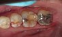 Silver Fillings. Before and After Photos: Patient 1 - frontal view
