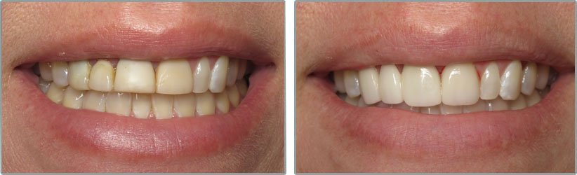 Dental Implants. Before and After Photos: Patient 1 - frontal view