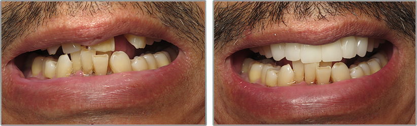 Dental Implants. Before and After Photos: Patient 2 - frontal view