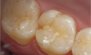 Fillings. Before and After Photos: Patient 10 - frontal view