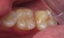 Fillings. Before and After Photos: Patient 10 - frontal view