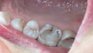 Amalgam Fillings. Before and After Photos: Patient 7 - frontal view