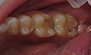 Fillings. Before and After Photos: Patient 9 - frontal view