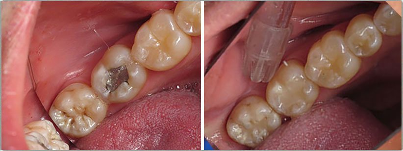 Silver Fillings. Before and After Photos: Patient 5 - frontal view