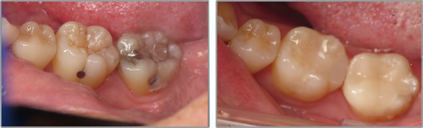 Fillings. Before and After Photos: Patient 11 - frontal view