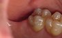 Fillings. Before and After Photos: Patient 12 - frontal view