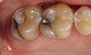 Fillings. Before and After Photos: Patient 14 - frontal view
