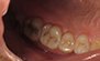 Fillings. Before and After Photos: Patient 15 - frontal view