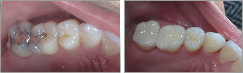 Inlay. Before and After Photos: Patient 3 - frontal view