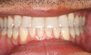 Invisalign. Before and After Photos: Patient 1 - frontal view