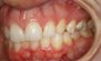 Invisalign. Before and After Photos: Patient 4 - frontal view