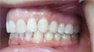Invisalign. Before and After Photos: Patient 3 - frontal view