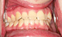 Invisalign. Before and After Photos: Patient 2 - frontal view
