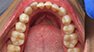 Invisalign. Before and After Photos: Patient 5 - frontal view