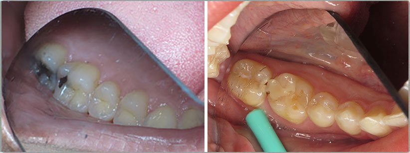 Silver Fillings. Before and After Photos: Patient 1 - frontal view