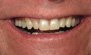 Teeth Whitening. Before and After Photos: Patient 4 - frontal view