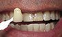 Teeth Whitening. Before and After Photos: Patient 5 - frontal view
