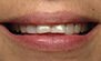 Teeth Whitening. Before and After Photos: Patient 6 - frontal view