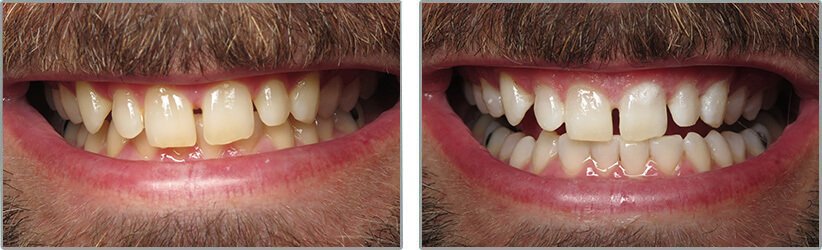 Teeth Whitening. Before and After Photos: Patient 7 - frontal view