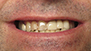 Porcelain Veneers. Before and After Photos: Patient 12 - frontal view