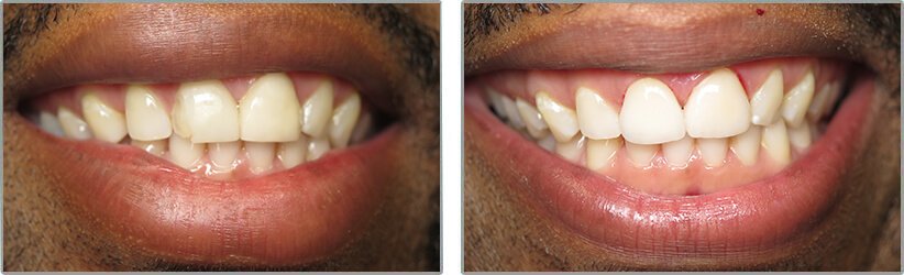 Porcelain Veneers. Before and After Photos: Patient 8 - frontal view